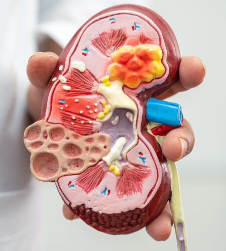 cancerul renal