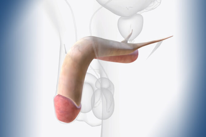 Circumcizia cu laser CO₂