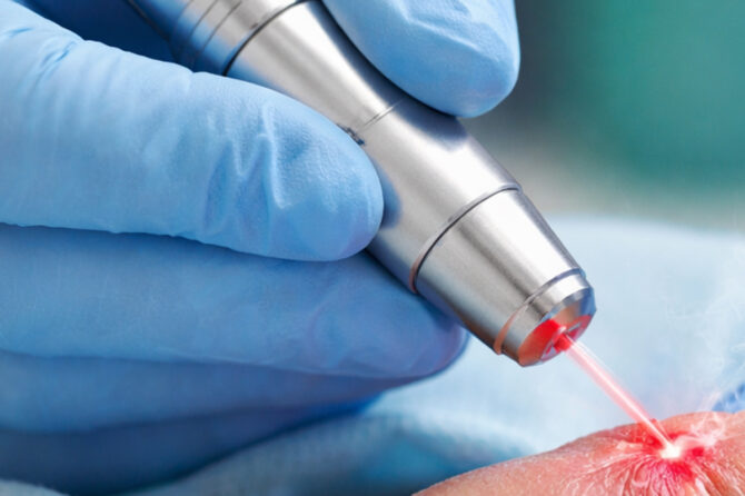 Frenotomia cu laser CO₂