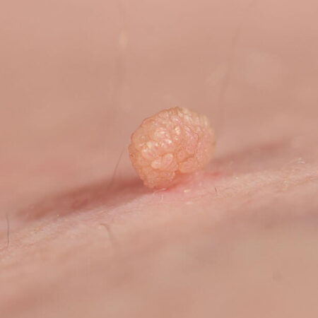papilloma skin growth