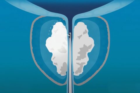 Terapia Rezūm™ pentru prostată